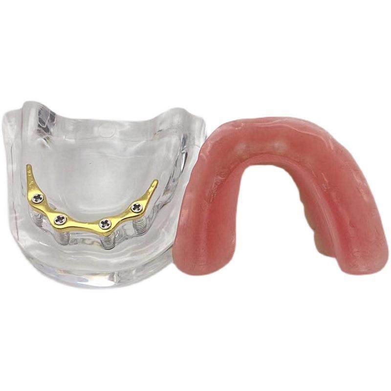 牙科口腔科模型医患沟通2四4颗钉模型新种植与修复模型包邮,文具电教/文化用品/商务用品,教学标本/模型,淘宝优惠券,粉丝福利购,淘宝优惠卷