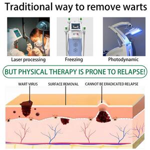 好货Wart Remover Liquid Effective Removal Of Flat Warts Reme