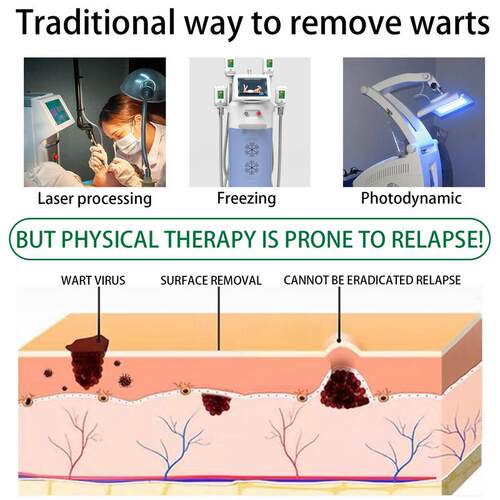 好货Wart Remover Liquid Effective Removal Of Flat Warts Reme