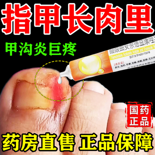 甲沟炎治疗专用药膏嵌甲真菌感染红肿发炎疼痛皮肤真菌抗菌消炎药