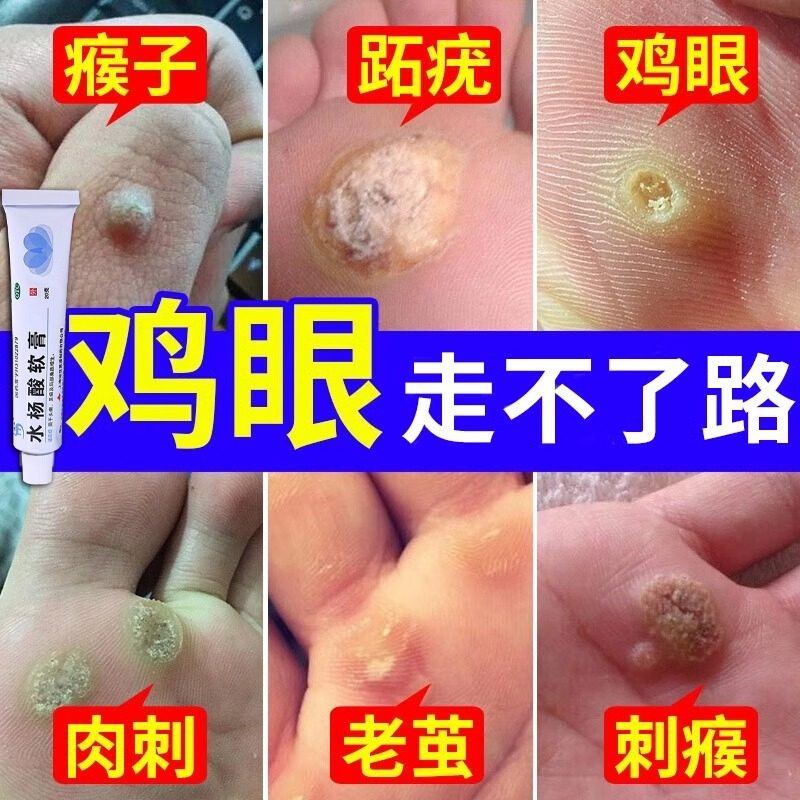水杨酸软膏正品鸡眼药膏跖疣老茧软化去角质头廯足癣止痒杀菌药膏