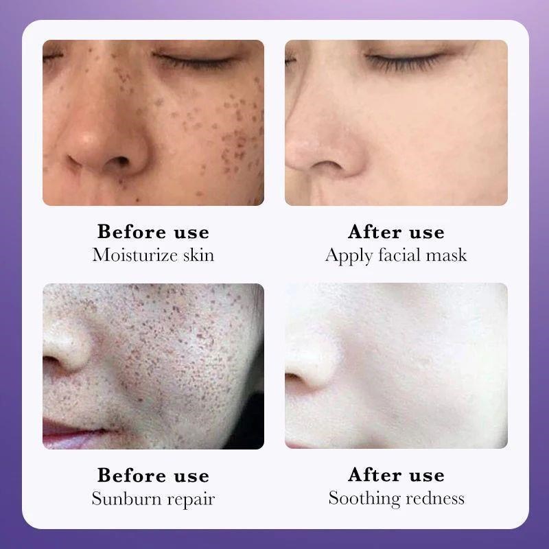 Nicotinamide Whitening Cream Remove Freckles Melasma Dark Sp