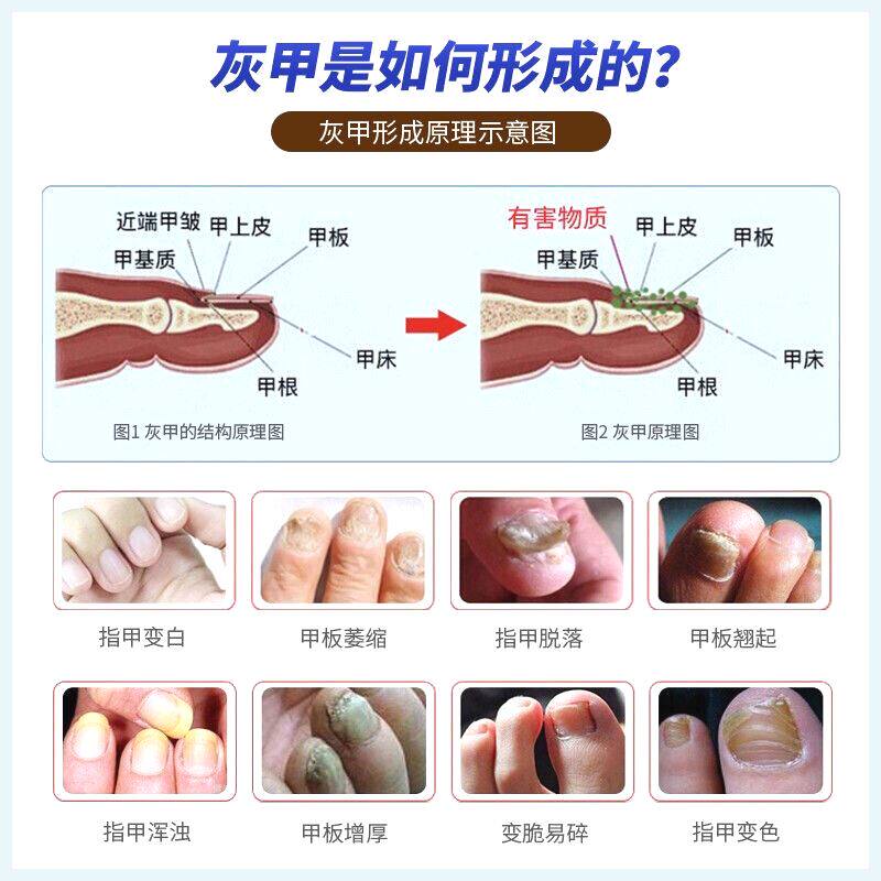 灰指甲打磨机器电动磨甲器硬脚趾甲修甲专用工具锉刀老人灰厚指甲