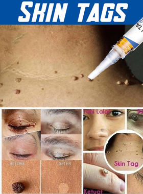 Skin Tag Remover Agat Moles 12 Hours Fast Removal Genital Wa