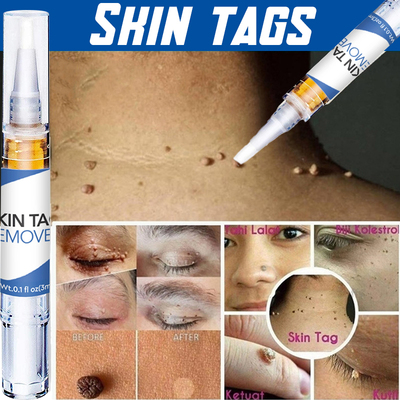 Skin Tag Remover Agat Moles 12 Hours Fast Removal Genital Wa