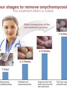 Nail Fungus Toe Repqair Onychomycosis Foot Mushroom Remedy液