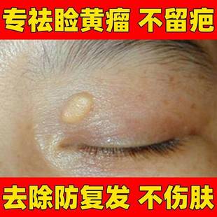 新品(艾游)伊掌柜草本睑黄膏修护膏眼疣睑黄瘤膏脸部黄斑瘤汗管