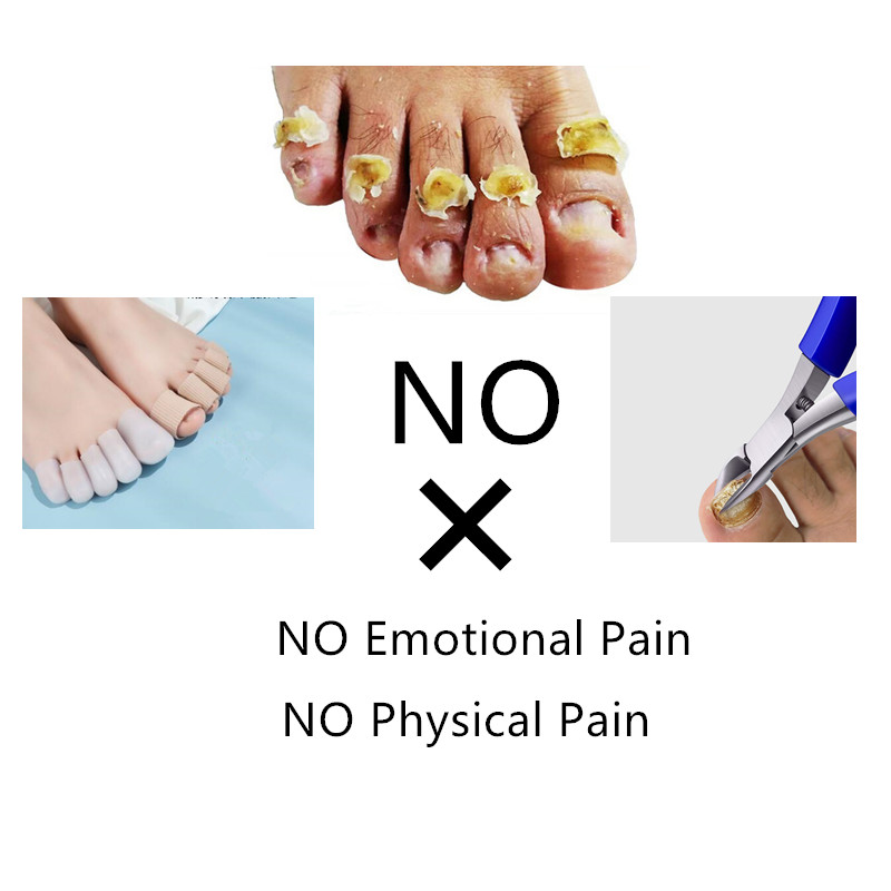 Extra Strong Nail Fungal Treatment Feet Care Essence Anti In