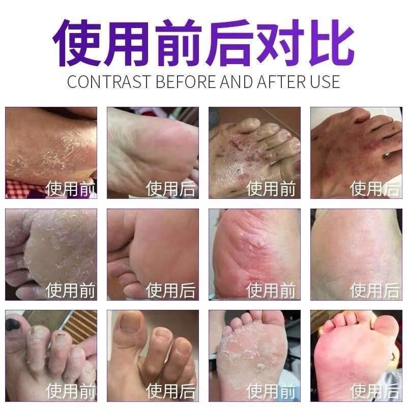 脚藓一次净烂脚丫药脱皮糜烂脚趾缝烂痒开裂脚趾头痒脚上长水泡痒