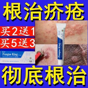疥疮苍膏渗透皮下杀疥虫卵疥疮结节爨癵不复发(买2送1买5送3)
