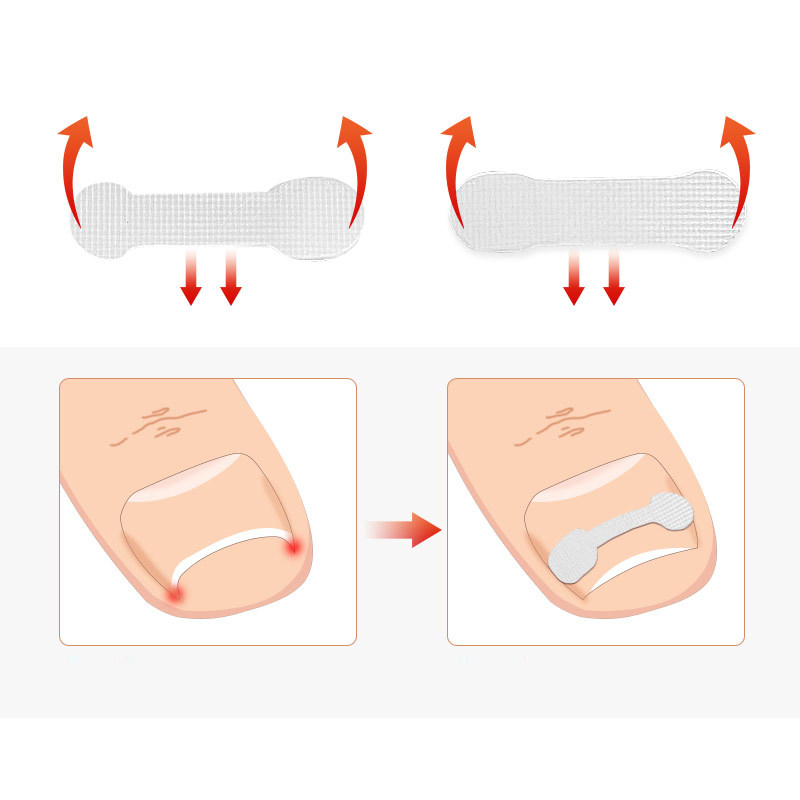 4-20PCS Nail Correction Stickers Paronychia Treatment