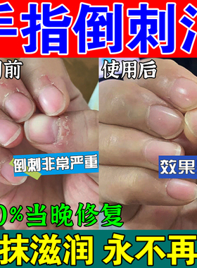 好货手指边缘护理油死皮倒刺指甲快速营养油起皮肉刺修复去角质软