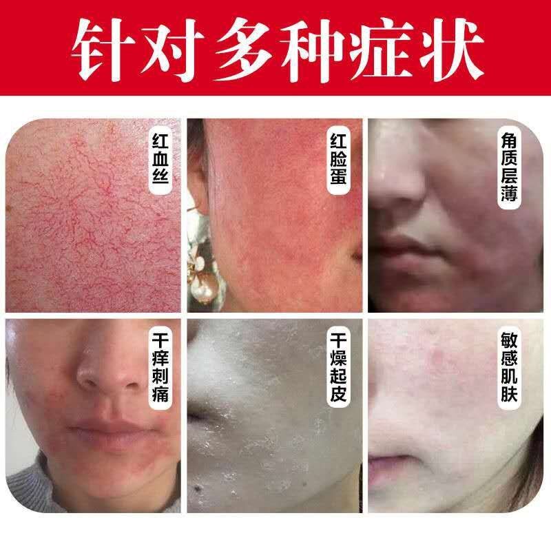 去红血丝修复角质层去除脸部过敏皮肤脸颊泛红修复受损肌肤护肤品