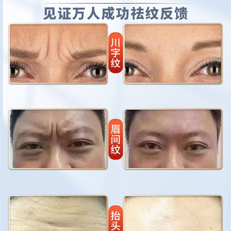 川字纹去除神器抬头纹额头纹眉间皱纹法令纹男女士消除提拉紧致贴