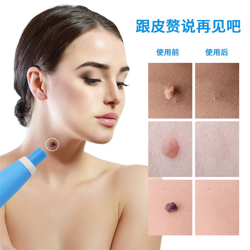 血管痣去除红痣斑血管皮肤身上长小红点去除血管痣膏幼儿血痣药