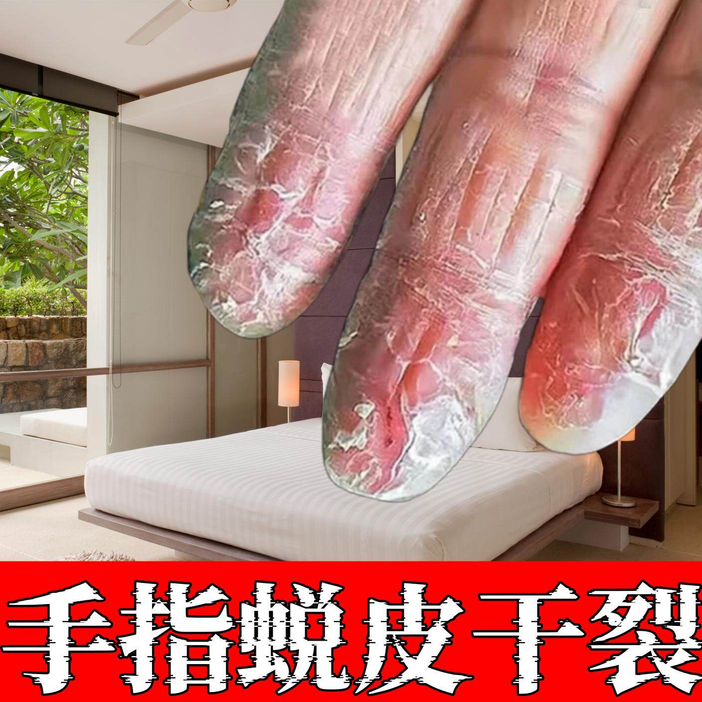 手足脱皮干裂膏手指上起皮干燥爆皮儿童手掌蜕皮心手脚掉皮褪专用