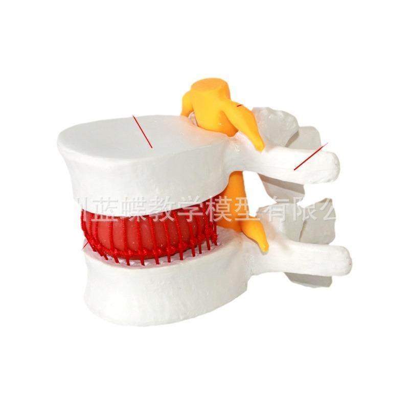 人体腰椎间盘受压演示模型腰椎放大模型病态脊柱脊椎骨骼关节模型,文具电教/文化用品/商务用品,教学标本/模型,淘宝优惠券,粉丝福利购,淘宝优惠卷