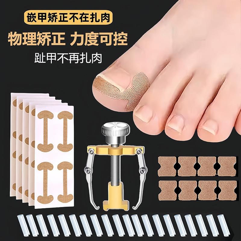 大脚趾指甲矫正器甲沟嵌甲