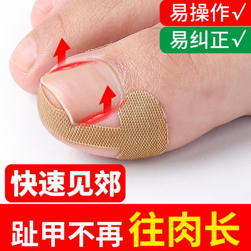 大脚趾指甲矫正器甲沟嵌甲