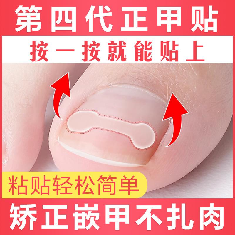大脚趾指甲矫正器正甲贴甲