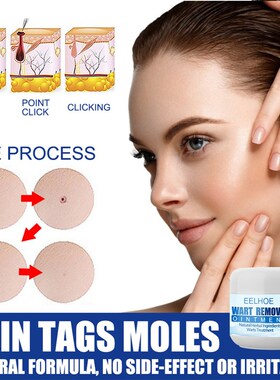 Wart Remover Safe Painless Skin Tags Removal Ointment Fast