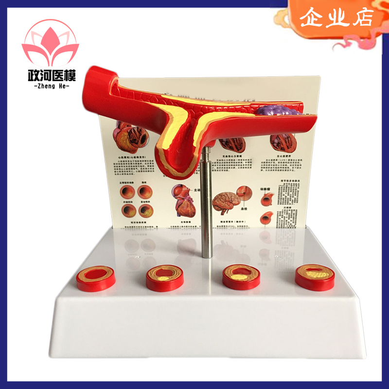 人体血管模型人体支脉粥样1硬化 心血管动脉1.硬化模型 血栓 模具