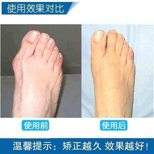 大母脚趾纠正姆大脚拐骨男女士型可以穿鞋保护套拇指内外翻矫正器