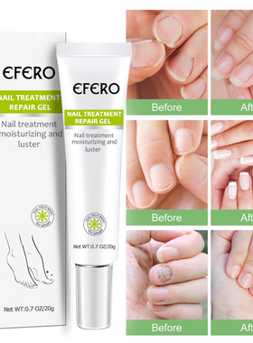 Fungal Nail Treatment Serum Nail Foot Nail Fungus Removal Ge