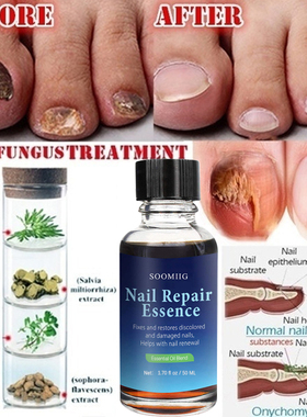 Solu??o de cuidados com as unhas para paronquia infeccio