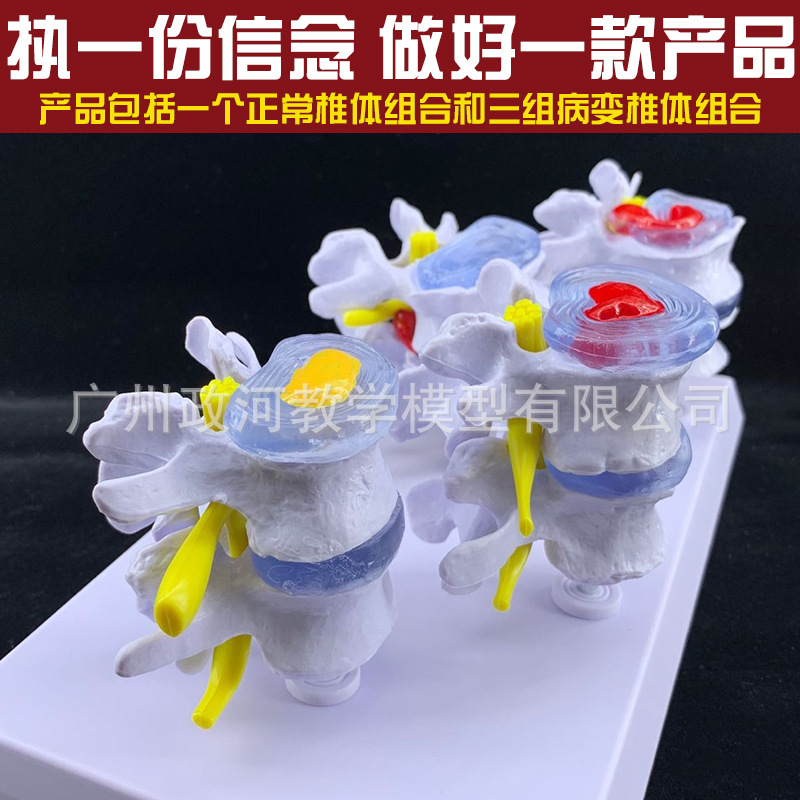 病理腰椎模型四队4对腰间盘病变模型椎间盘病理模型 关节模型
