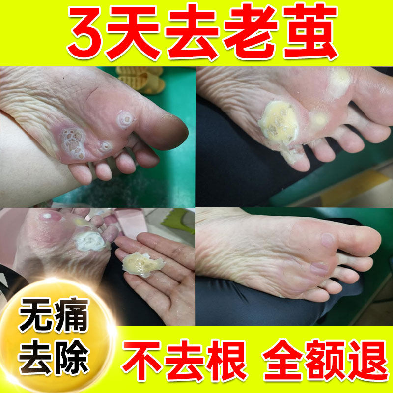 极速清茧灵脚茧脚底老茧手茧祛去除茧子膏神器药死皮软化剂足手脚