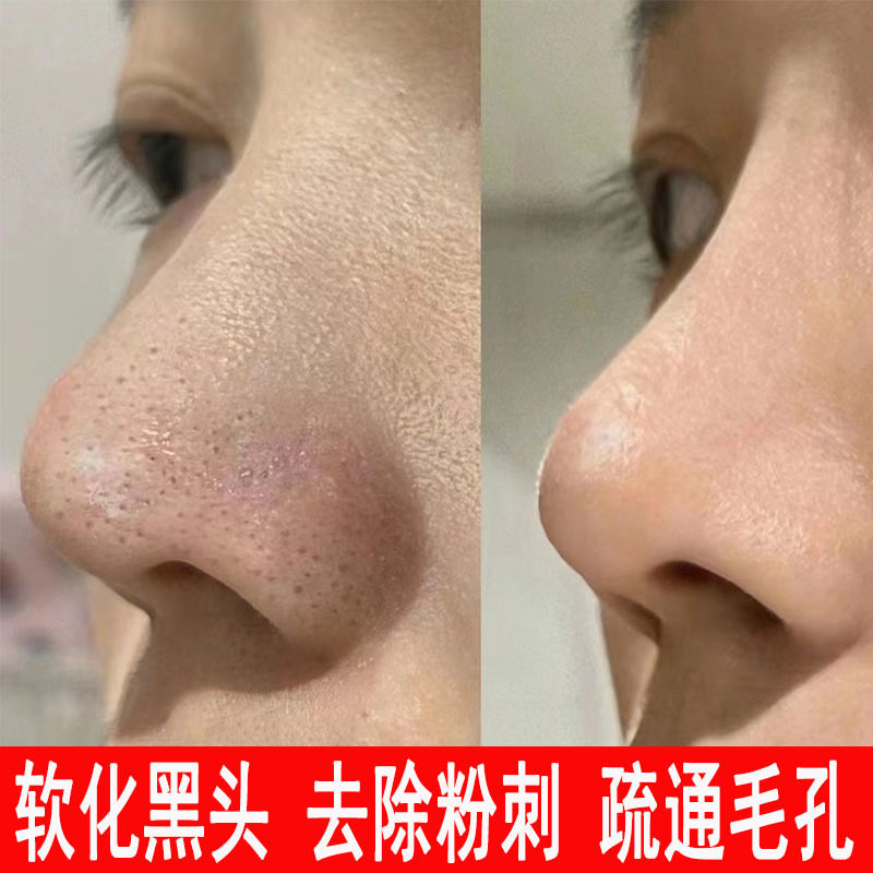黑头导出液去黑头院装小气泡粉刺净化毛囊软化角质收缩毛孔精华液