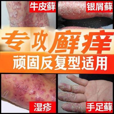 头皮癣癣苗草癣手藓脱皮开裂藏药癣藓毒王肤1专家癣王菌癣康