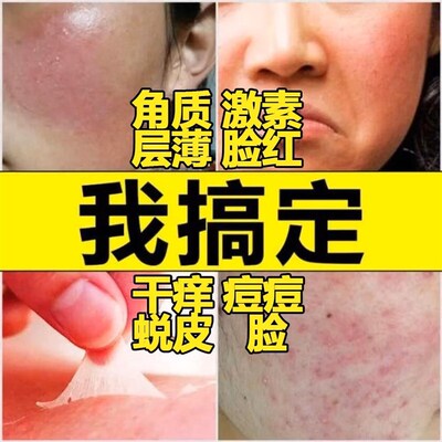 儿童脸上长过敏起眼皮脸干燥起皮过除面部眼部保湿修复霜