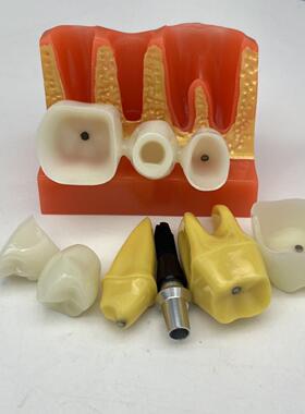 牙齿口腔教学模型四倍种植体模型牙科可拆卸义齿连桥冠烤瓷修复