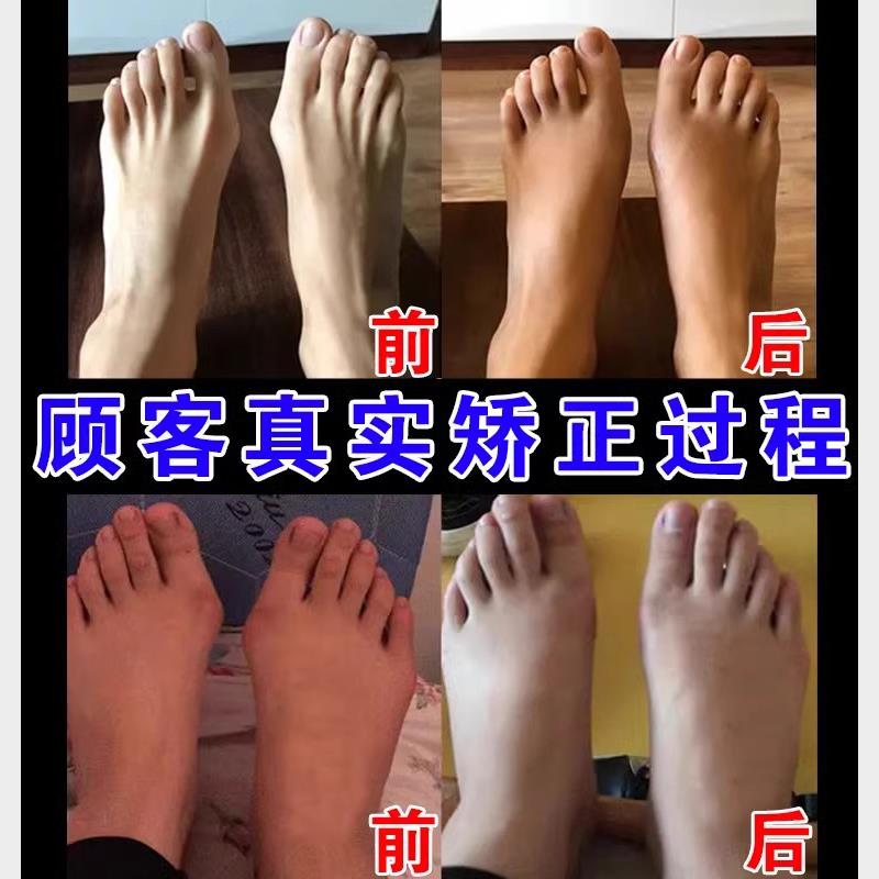 拇指外翻贴非矫正器脚趾重叠防磨大脚趾骨疼痛外翻贴拇药专用贴膏