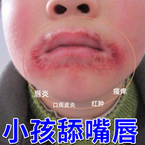 【药监备案】儿童唇炎专研