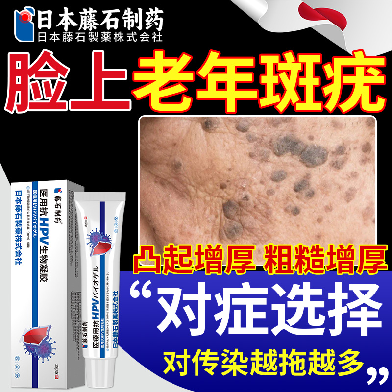 去脸上扁平疣老年斑除软膏一抹灵增厚凸起老人疣黑斑OM