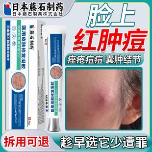 脸上疖肿结节硬块痘痘起硬疙瘩囊肿脓包型祛痘膏药房同售OM