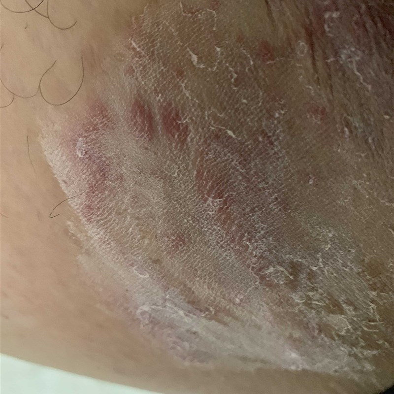 速发草体实药店】晟恩斩【除根药膏止痒药膏皮肤