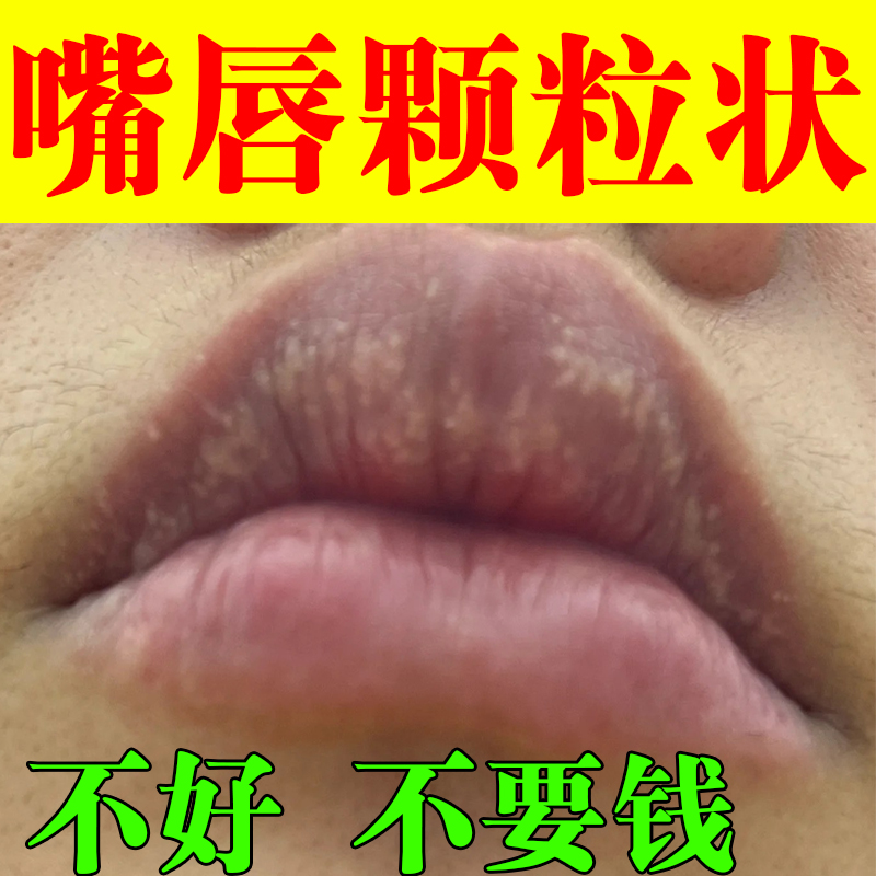 皮脂腺异位嘴唇颗粒状专用药去除嘴角起皮红肿水泡白点脂肪颗粒