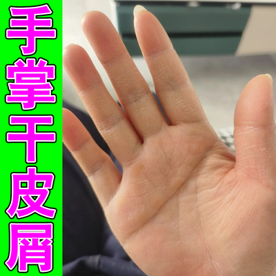 手干燥粗糙掉皮皮肤裂口冶手裂口的修复膏手指上起皮
