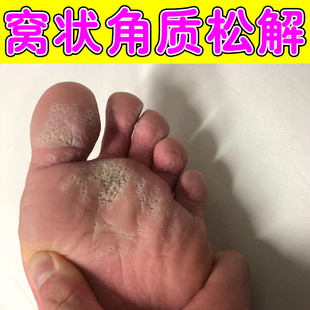 脚底蜂窝状沙虫脚起水泡脚底发白发臭窝状角质松解症专用