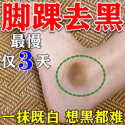 脚踝发黑脚脖子去黑除腋下脖子指关节膝盖手肘黑色素沉淀美白神器