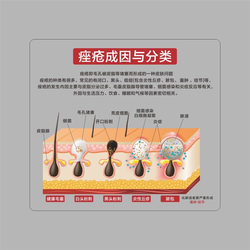 医美知识展示牌四大问q题肌肤成因亚克力台牌桌牌斑敏痘衰台卡
