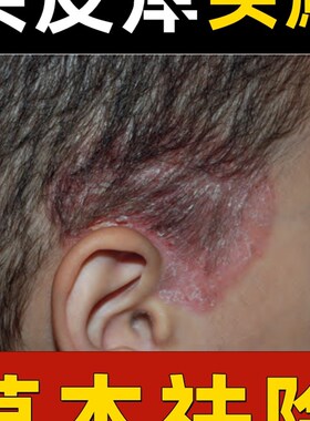 毛襄炎药去头皮囊炎治头皮癣的毛皮囊炎喷剂