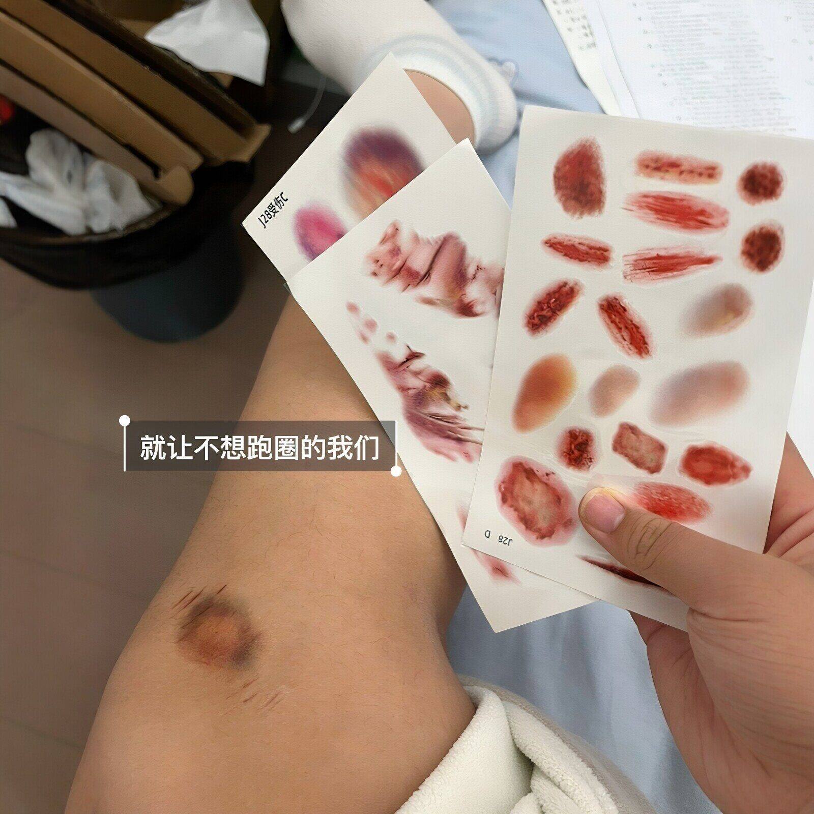 【跑操请假神器】超逼真3D淤青纹身贴纸学生请假整蛊老师疤痕贴纸