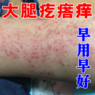 腿痒天热小腿痒起红疙瘩长红斑疹子红肿刺挠干燥起皮脱屑外用软膏