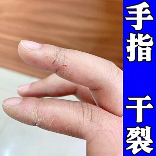 手指脱皮干裂口真菌修复霜手痒干燥起硬皮增厚膏