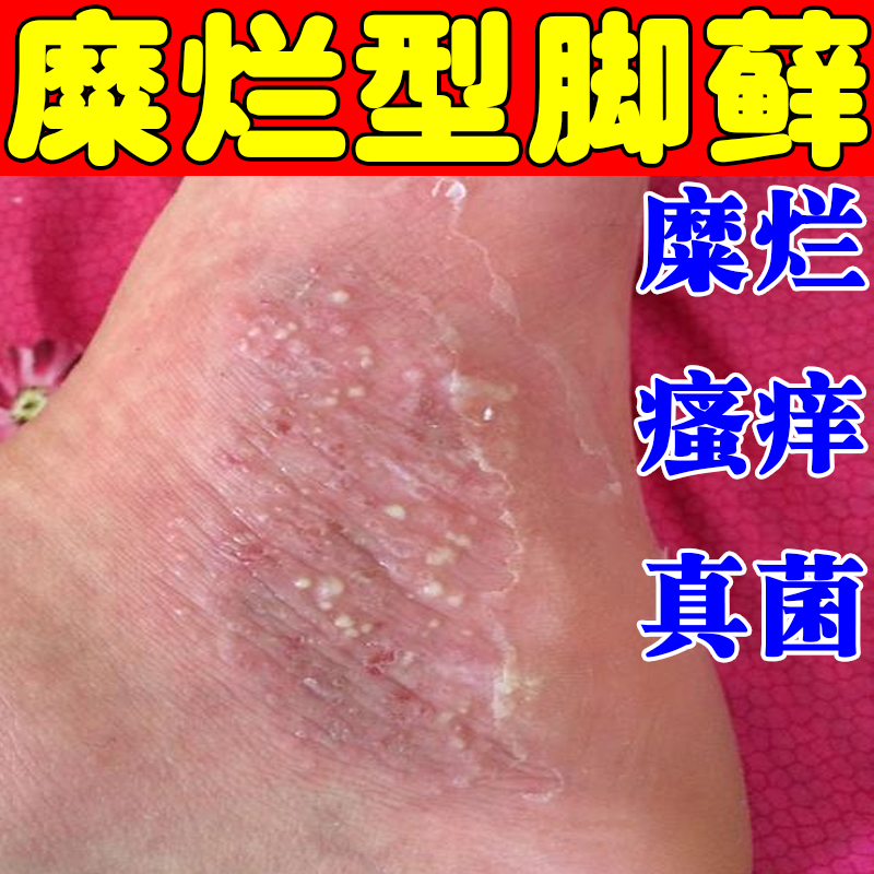 祛脚藓水疱型脚臭脚脚底起小水泡